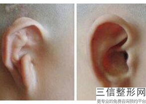 北京外耳再造医院哪家好呢，小耳畸形再造哪家医院良好