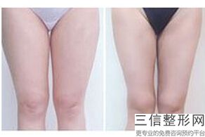 北京英煌赵丹杨丰胸，英煌赵丹杨胸下垂办法