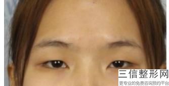 北京张冰洁修复内眼角怎么样，张冰洁修复外眼角怎么样