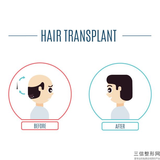 北京植发的价格一般是多少，新生植发需要多少钱