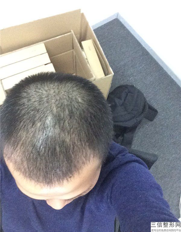 北京中德植发医院怎么样，植发fue技术怎么样