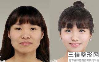 北京做面部提升好的医院排名前三，北京面部提升良好的哪家医院