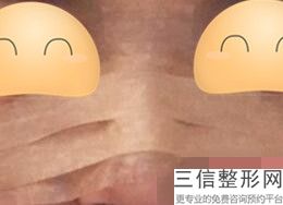 鼻部骨粉取出，骨粉隆鼻取出后是什么样的
