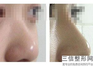 鼻部骨粉取出，骨粉没取干净隆鼻