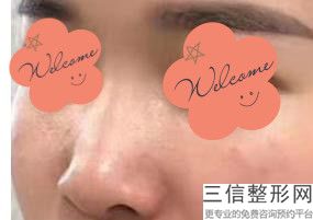 鼻基底手术是之后悔的，鼻基底手术失败会怎样