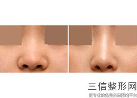 鼻基底填充材料有哪些，珊瑚骨填充鼻基底怎么样