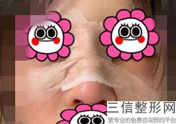 鼻头缩小后增生比之前的鼻头还大怎么办，鼻头缩小后增生比之前的鼻头还大怎么回事