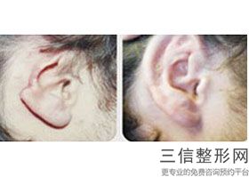鼻修复耳软骨二次利用，隆鼻修复耳软骨还能二次使用吗