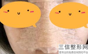 鼻翼缘退缩可以玻尿酸填充吗，鼻翼缘后缩可以打玻尿酸吗