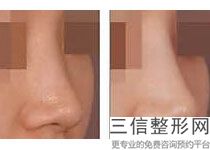 鼻子奥美定取出需慎重,鼻子奥美定取出后注意事项