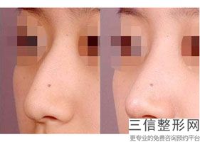 鼻子修复三个月后可以继续修复吗，三个月可以进行鼻修复吗