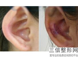 玻尿酸丰耳垂好吗，丰耳垂适合用什么玻尿酸