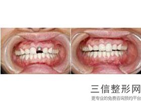 补牙树脂材料品牌排行榜前十名有哪些，补牙树脂材料哪个牌子好