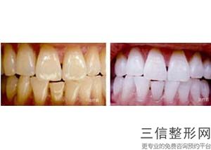 补牙用美国3M树脂多少钱，3m进口树脂补一颗牙多少钱
