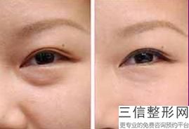 常州祛眼袋手术哪家好，常州祛眼袋手术哪家好些