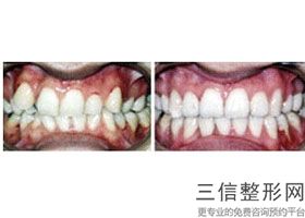 常州种植牙哪家好，常州哪家种植牙好又便宜