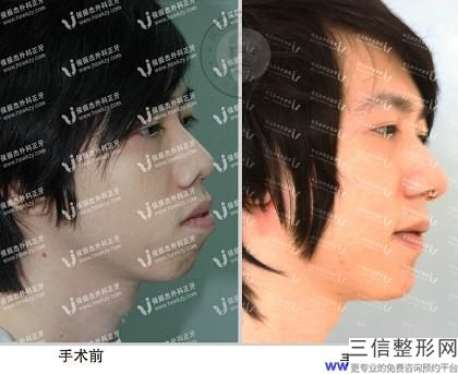 常州自体脂肪填充医院哪家好除了常州美贝还有什么，长沙自体脂肪填充医院哪种好