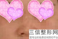 超肋做鼻头好嘛，超肋隆鼻怎么样