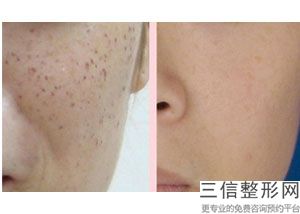 超声炮和热玛吉哪个好，热玛吉和超声刀对比