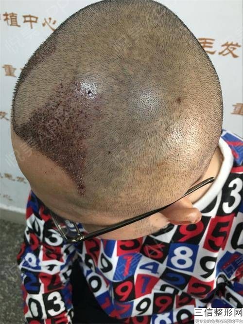 郴州有没有植发医院，郴州市第一人民医院植发