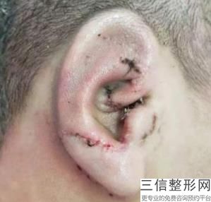 成都耳朵整形大概需要多少钱在,成都耳朵整形大概需要多少钱在赞扬民生耳鼻喉
