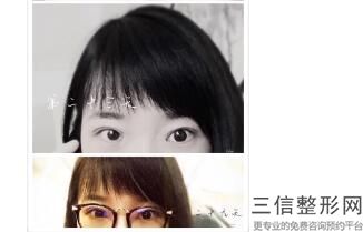 成都美莱整形医院雷蕾怎么样,成都黄小林双眼皮价格
