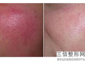 成都美莱做热玛吉怎么样，做热玛吉全脸部价格表