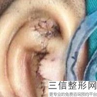 成都哪家医院做小耳畸形再造好，成都哪家医院做小耳畸形再造好些