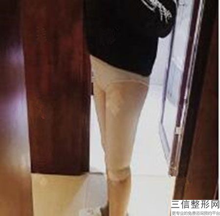 成都西区医院宋华敬抽脂如何，西安西京医院大腿抽脂