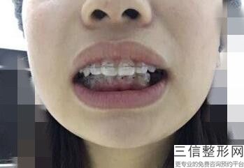 成都牙齿矫正李文星医生，成都牙齿矫正李文星医生