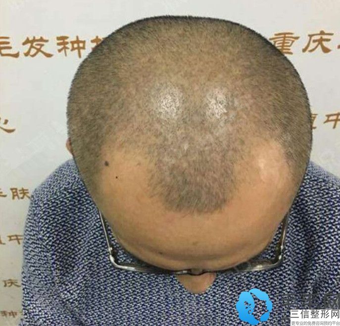 成都植发哪家医院口碑好，成都正规植发医院排行