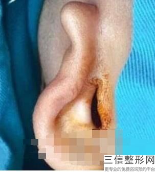 成都治疗小耳畸形良好的医院，四川耳朵畸形整形医院