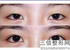 成都做双眼皮修复医生排名，成都良好的双眼皮修复专家