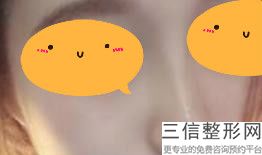 赤峰哪个医院做鼻子好呢多少钱，赤峰哪个医院做鼻子好呢