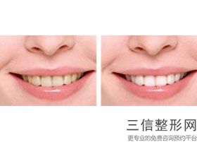 赤峰市种牙都有什么价位的，赤峰种植牙齿需要多少钱