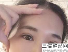 赤峰有做眼袋手术多少钱，祛眼袋赤峰哪家医院好