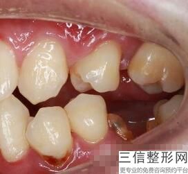 崇左矫正牙齿多少钱一颗，崇左矫正牙齿多少钱