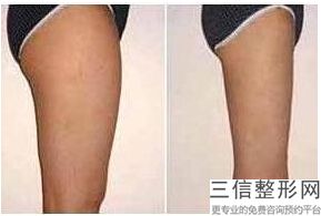 徐州大腿吸脂好的医院是哪家，徐州大腿吸脂好的医院