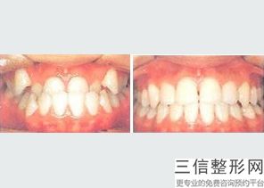 徐州口腔医院价格表 种植牙，徐州口腔医院种植一颗牙要多少钱