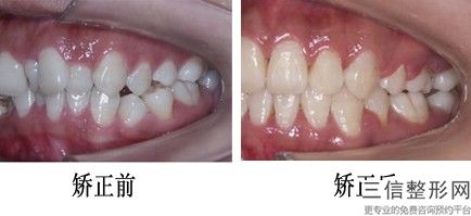徐州瑞康口腔医院价格表,国产种植牙350元，徐州瑞康口腔医院价格表,国产种植牙350一颗