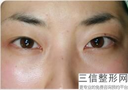 徐州双眼皮修复医院排名榜前十名，徐州双眼皮修复医院排名榜前十