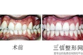 徐州种植牙多少钱一颗2022韩国种植牙价格，徐州种植牙多少钱一颗2022韩国种植牙多少钱