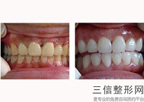 牙齿打桩做牙套一般能用多久时间，牙齿打桩做牙套一般能用多久啊
