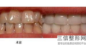 牙齿松动分为几个等级，牙齿松动的等级共有几个各级应该怎样处理