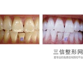 牙齿正畸牙龈严重萎缩，正畸导致的牙龈萎缩怎么办