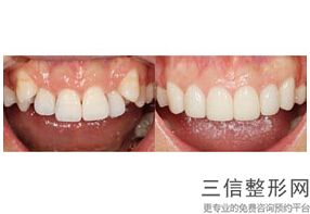 牙齿种植价格直推东莞口腔医院，东莞市种植牙