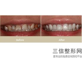 牙周炎刮治费用是多少钱,牙周炎刮治费用是多少