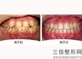 牙周炎牙齿二度松动，牙周炎,牙一度松动和二度松动能好吗