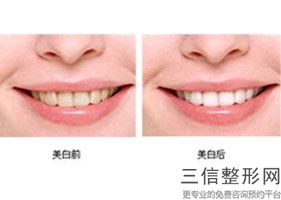 烟台华怡口腔中心种植牙怎么样，威海华怡口腔医院怎么样
