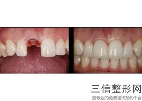 烟台华怡口腔中心种植牙怎么样，威海种植牙多少钱